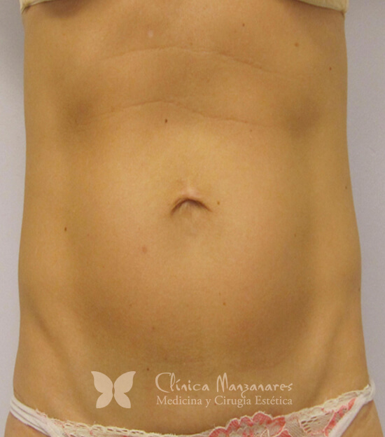 Carboxiterapia abdominal antes