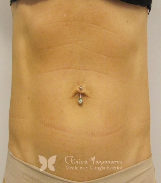 Carboxiterapia abdominal después