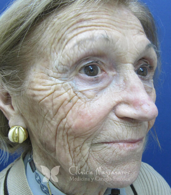 Tratamiento de Rejuvenecimiento facial antes