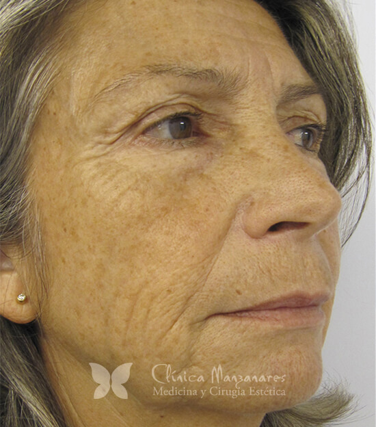 Tratamiento de Rejuvenecimiento facial antes