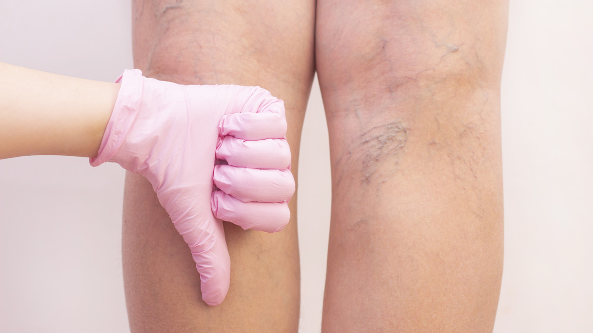 Mitos sobre las varices y eliminarlas |